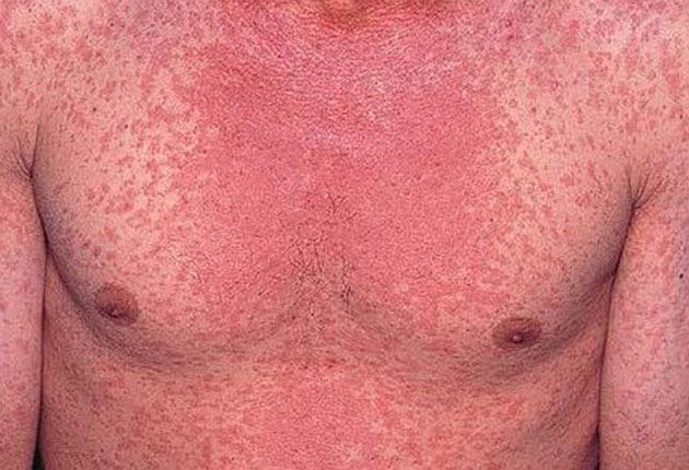 Zeci de cazuri de rujeolă, la Giurgiu. În ce perioadă s-au înregistrat