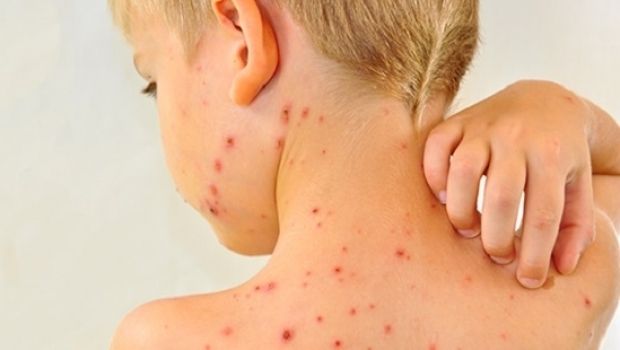 Alarmant! 13 cazuri de rujeolă într-o săptămână, la Giurgiu