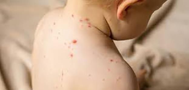 Rujeola revine în forță! Câte cazuri sunt la Giurgiu