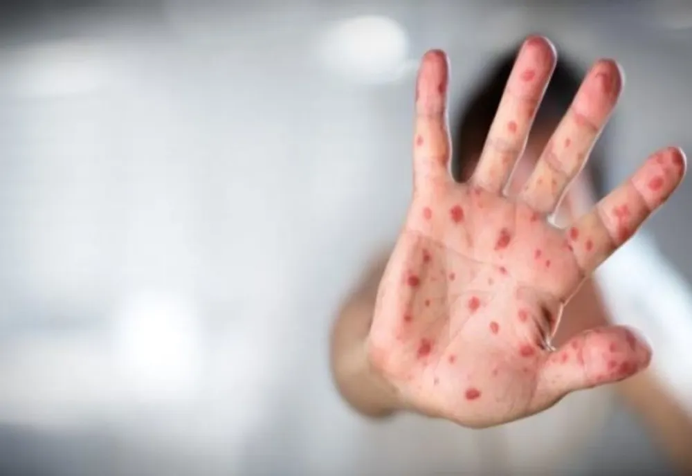 INSP: 701 cazuri noi de rujeolă înregistrate în ultima săptămână; două decese